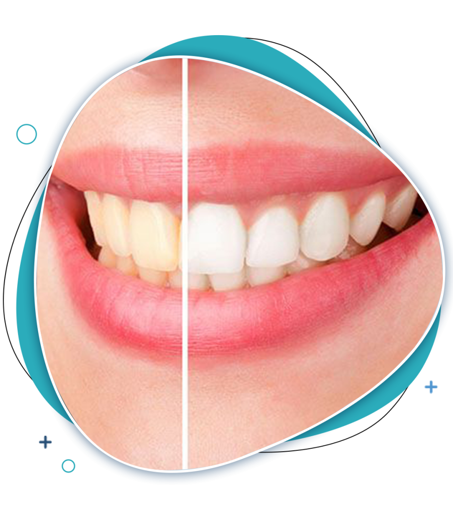 Teeth Whitening Glen Waverley EK Dental Surgery